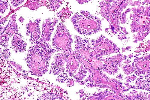 Hereditary leiomyomatosis and renal cell carcinoma associated RCC -- intermed mag.jpg