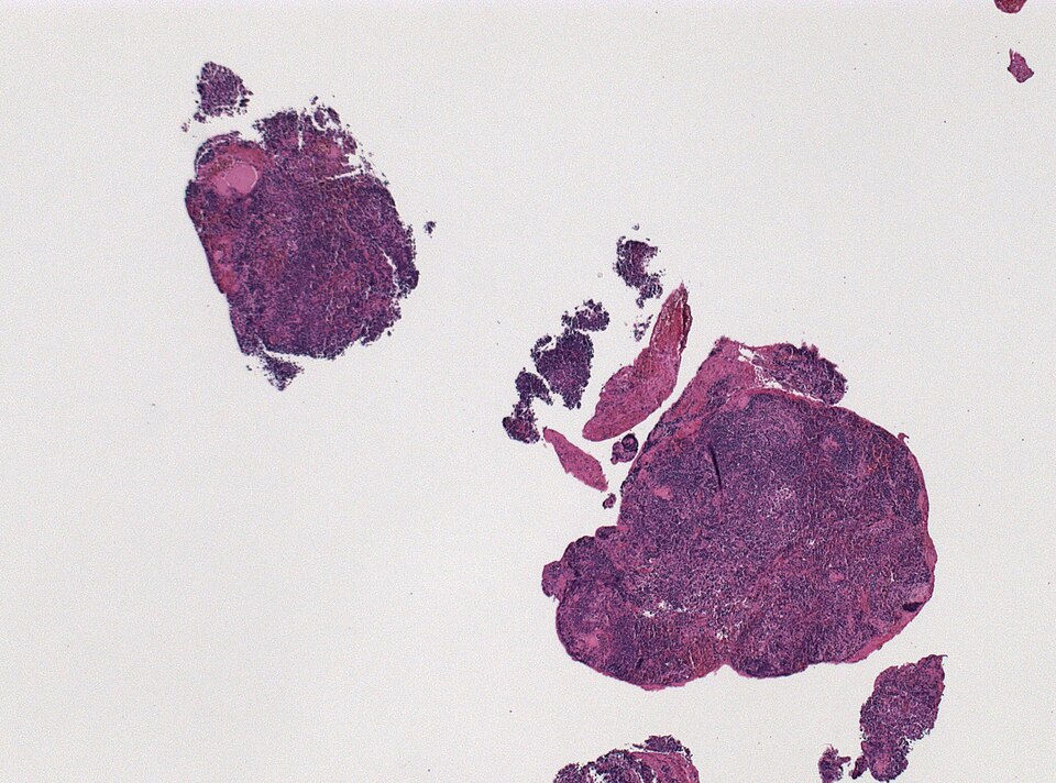 File:Neuropathology case VIII 01.jpg