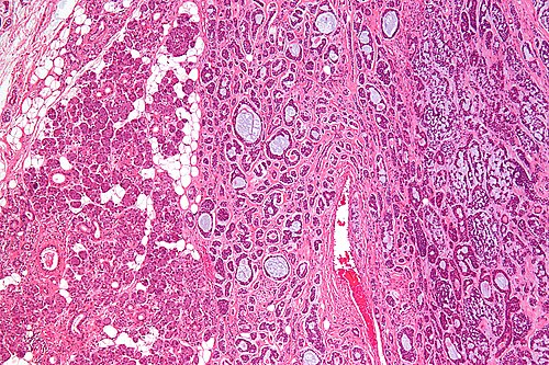 Adenoid cystic carcinoma - low mag.jpg