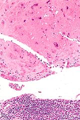 Placental site nodule - Libre Pathology