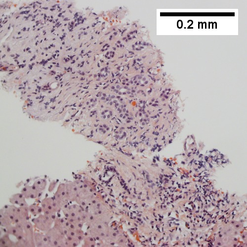 Tortuous bile ductsductules, not to be considered generalized in presence of mass (200X).
