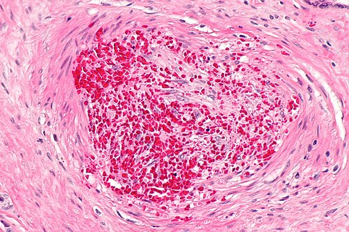 Fetal thrombotic vasculopathy -- high mag.jpg
