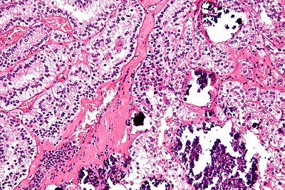 Xp11.2 translocation renal cell carcinoma - high mag.jpg