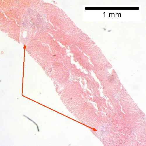 Inflamed triads [arrows] amid undisturbed hepatocytes (Row 1 Left 40X).