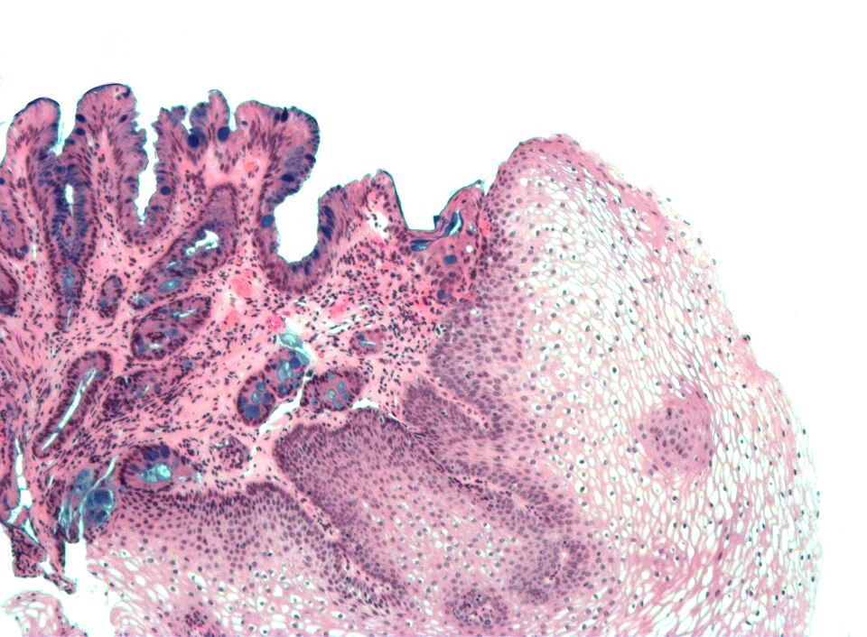 File:Barretts alcian blue.jpg