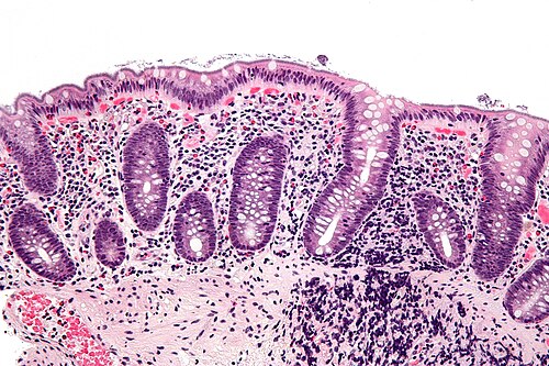 Intestinal spirochetosis - high mag.jpg