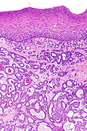Cribriform adenocarcinoma of the tongue - a1 -- intermed mag.jpg