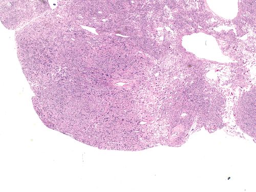 Atypical leiomyoma with bizarre nuclei low magnification 2.jpg