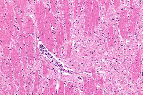 Intravascular lymphoma - intermed mag.jpg