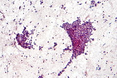 Thyroid cytopathology - Libre Pathology