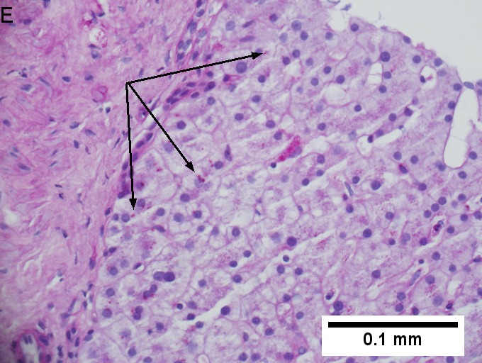 Alpha 1 anti-trypsin (A1AT) granules in cirrhosis, not due to A1AT deficiency; A1AT level was normal.