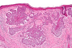 nevoid basal cell carcinoma syndrome histology