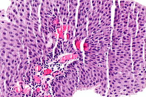 Papillary urothelial lesion of low malignant potential, Cancerul are simptome