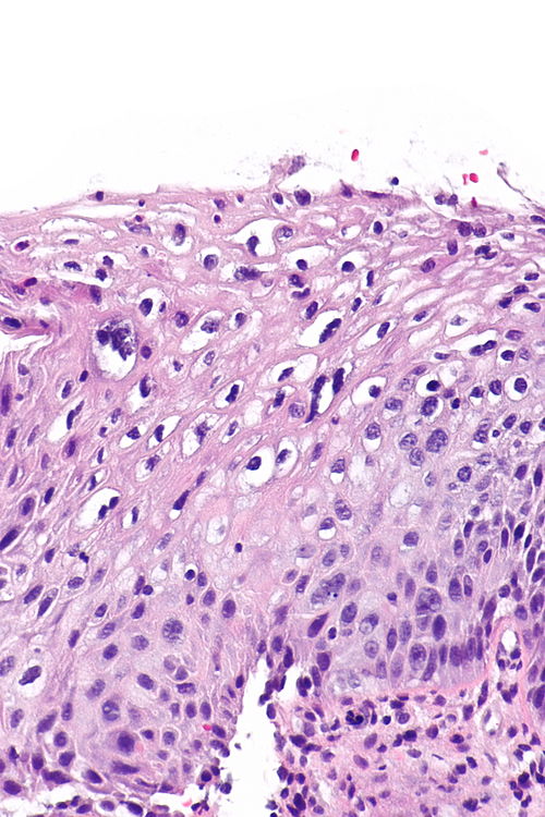 Low-grade squamous intraepithelial lesion -- high mag.jpg