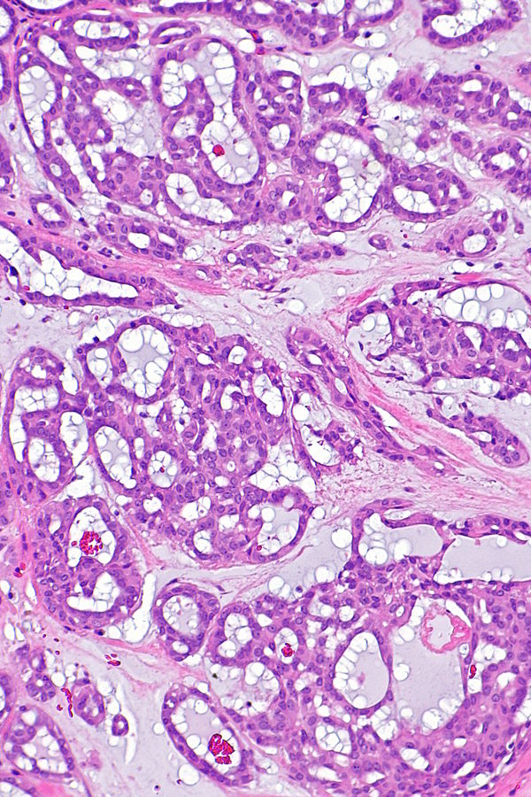Cribriform Adenocarcinoma Of The Minor Salivary Gland Libre Pathology