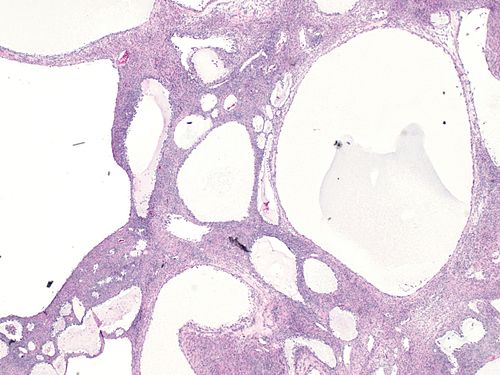 Tubulocystic clear cell carcinoma of the ovary.jpg
