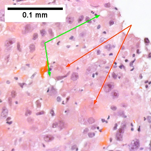 Vacuoles, mostly small, occasionally become large enough to warrant “macrovesicular” [green arrows]. Note Mallory hyalin [red arrows] (Row 1 Right 400X).