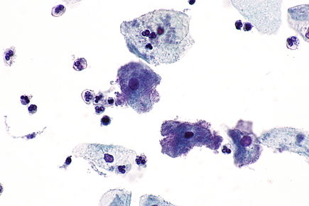 Clue cells - Pap test -- very high mag.jpg