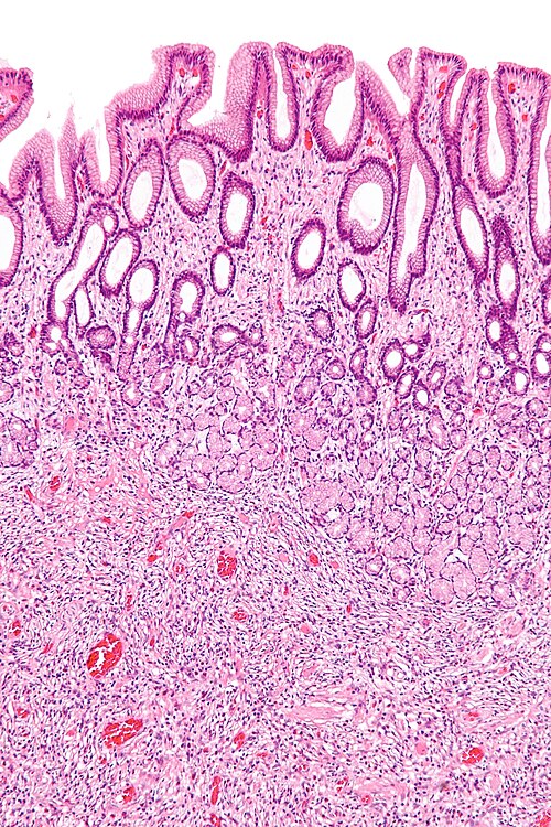 Inflammatory fibroid polyp - intermed mag.jpg