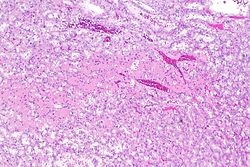 Eosinophilic, solid and cystic renal cell carcinoma - 3 -- low mag.jpg