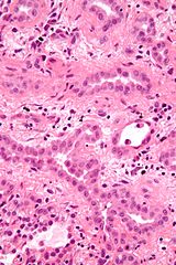 Gorgeous Fibrous Mesothelioma View in HD