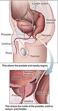 prostate infarction
