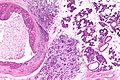 Salivary duct carcinoma -a- low mag.jpg