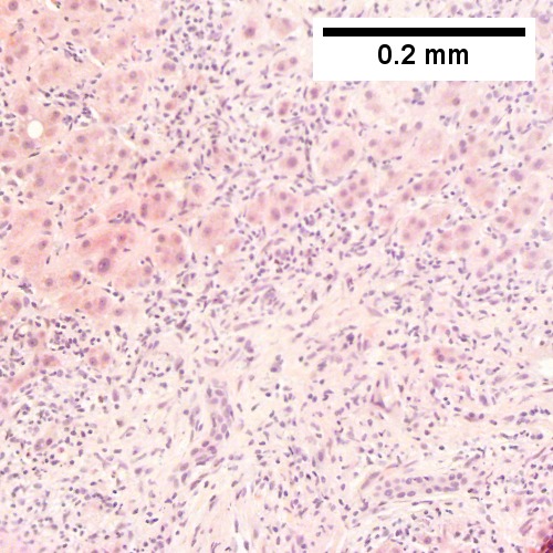 Apparent piecemeal necrosis with bile ductular proliferation (Row 2 Left 200X).