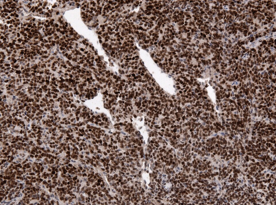 File:Neuropathology case VI 01.jpg
