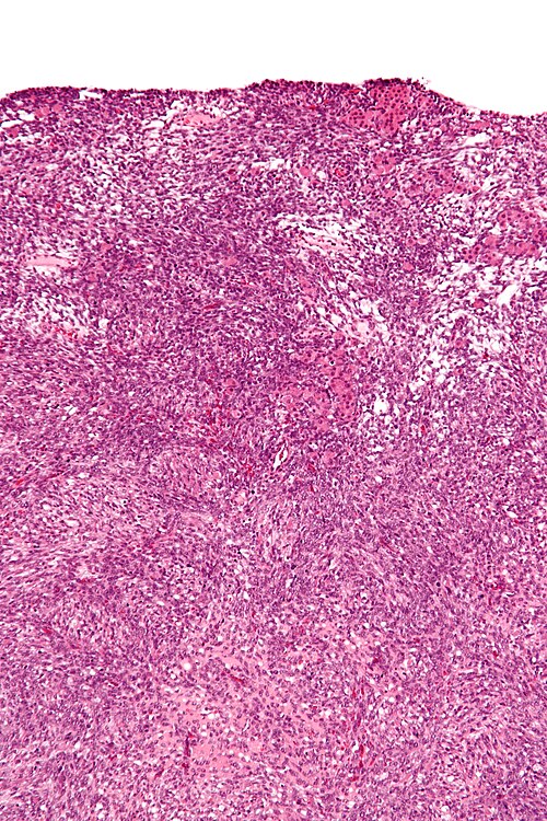 Sertoli-Leydig cell tumour - intermed mag.jpg