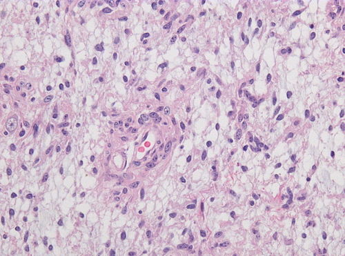 Neuropathology case V 03.jpg