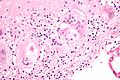 Granuloma annulare - Libre Pathology