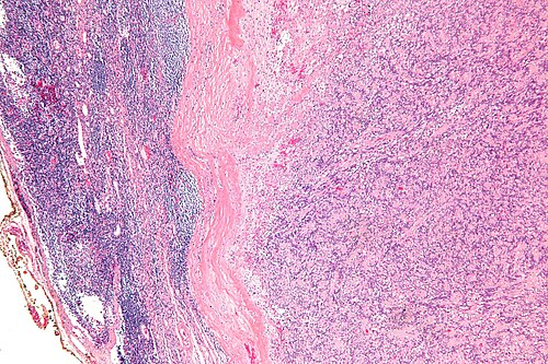 Intranodal palisaded myofibroblastoma - low mag.jpg
