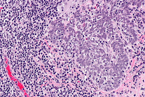Squamous cell carcinoma - p16 positive -- high mag.jpg