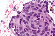 Endometrium with squamous morules - Libre Pathology