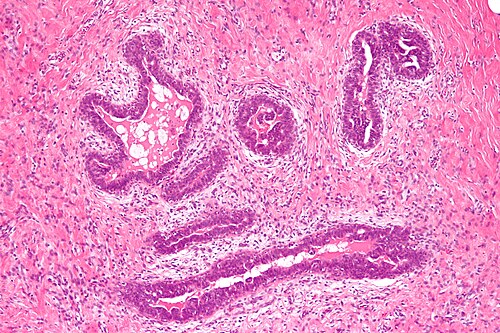 Gynecomastoid hyperplasia - intermed mag.jpg