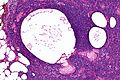Sebaceous lymphadenoma - intermed mag.jpg