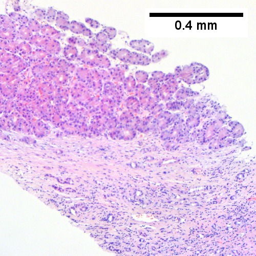 The fibrous band on right bears proliferating bile ductules; acinar arrangement on left shows holes much larger than canaliculi (Row 1 Right 100X).