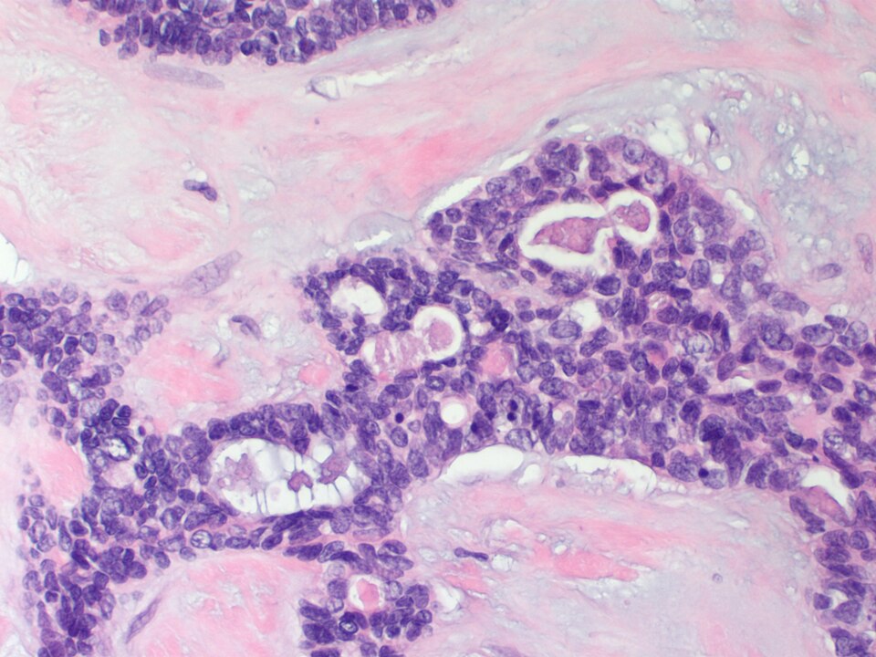 File:Breast AdenoidCysticCarcinoma 2 HP3 CTR.jpg