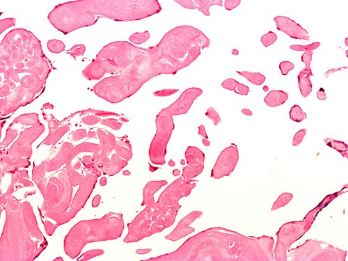 Papillary fibroelastoma2.jpg