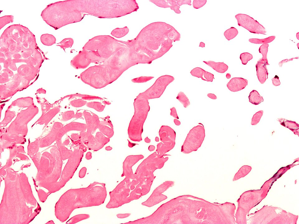 File:Papillary fibroelastoma2.jpg
