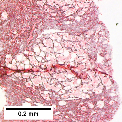 Reticulin shows regeneration (two nuclei per cord) in a nodule, but not throughout (Row 2 Right 200X).