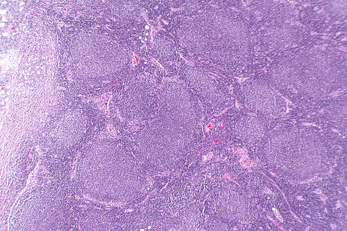Follicular lymphoma -- very low mag.jpg