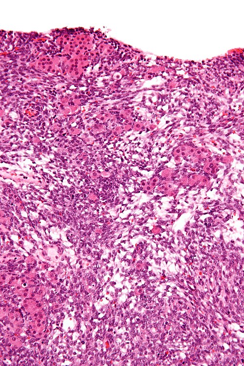 Sertoli-Leydig cell tumour - high mag.jpg