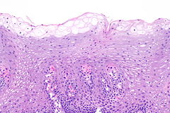 Glycogenic acanthosis of the esophagus - Libre Pathology