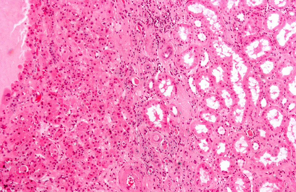 File:Renal oncocytoma2.jpg