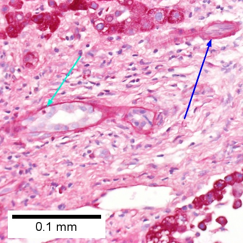 A PAS without diastase stain colors the arteriole (blue arrow), as well as the rim of the interlobular duct within which lies a neutrophil (cyan arrow) (Row 2 Right 400X). .
