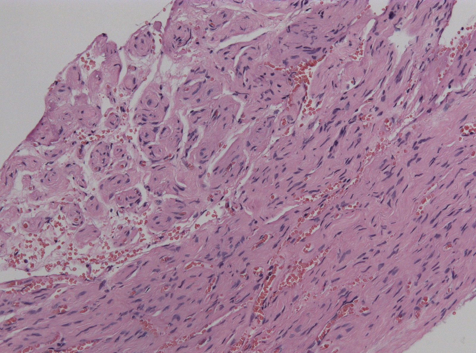 File:Perineurioma, HE Stain.jpg - Libre Pathology