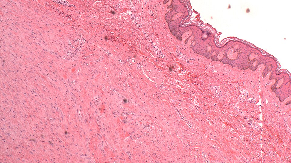 File:ScarHistology.JPG