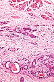 Cystic tumour of the atrioventricular nodal region - high mag.jpg